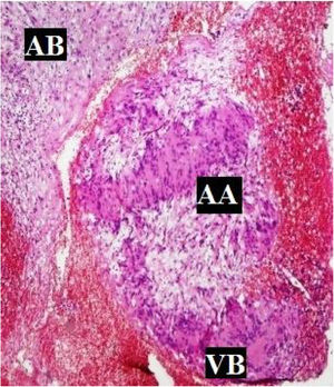 Histological picture showing characteristic features of schwannoma consisting of Antony A and Antony B areas. AA, Antony A areas consist of palisading of the nuclei around a central mass of cytoplasm called Verocay bodies. AB, Antony B areas contain a loose stroma with no distinct pattern by the fibres and cells. VB, Verocay Bodies – the central mass of cytoplasm around which nuclei are seen palisading in Antony A areas.