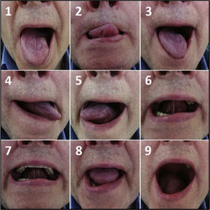 The nine movements of the tongue motility assessment in patient who underwent left partial glossectomy without flap reconstruction (primary closure).