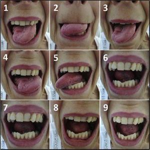 The nine movements of the tongue motility assessment in patient who underwent right partial glossectomy with pedicled flap reconstruction (platysma myocutaneous flap).
