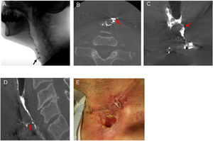 Videofluoroscopy and contrast CBCT findings of Case 2. A, Videofluoroscopy showing the leakage of contrast fluid. The black arrow indicates the leakage. B, Axial image of contrast CBCT showing the accurate location of leakage on the cervical side. C, Coronal image of contrast CBCT showing the accurate location of leakage on the pharyngeal side, which was located not at the midline, but on the left side. D, Sagittal image of contrast CBCT detected another leakage, which could not be observed by videofluoroscopy. The red arrows indicate the leakage. E, Appropriate surgical treatment was performed.