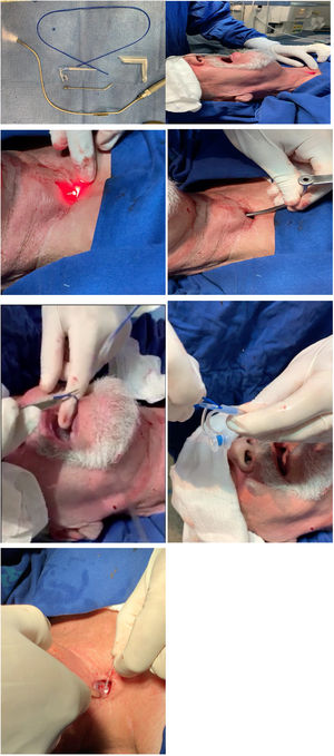 (A) Transillumination device. (B) Site of fistula demonstrated by the light. (C) Incision over the site. (D) An angled trocar is inserted and pushed in the esophageal lumen. (E) Semi-flexible device
