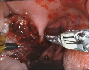 Friable exophytic mass at the right palatine tonsil with irregular borders and about 3 cm in diameter.