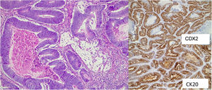 Histopathological examination of the resected palatine tonsil showed surface squamous epithelium with extensive infiltration of the tonsillar lamina propria by a glandiform epithelial neoplastic proliferation (H & E). The IHC study carried out in the neoplastic component showed positivity for CK20 and CDX2.