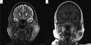 (A) Coronal T2 weighted MRI scan showing extensive temporomandibular growth of the left parotid tumor. (B) Coronal T1 weighted MRI scan showing the primary parotid tumor invading the temporomandibular joint and a synchronous tumor of the parotid tail.