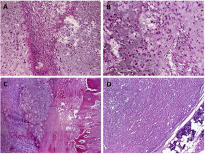 (A) Overview of the pleomoprhic adenoma showing chondromyxoid tissue (left) juxtaposed to oxalat-like stromal deposits. (B) Higher magnification of the transitional zone between the two components. (C) Some tumor lobules showed extensive metaplastic ossification. (D) The second pleomorphic adenoma showed extensive stromal sclerosis but no other features.