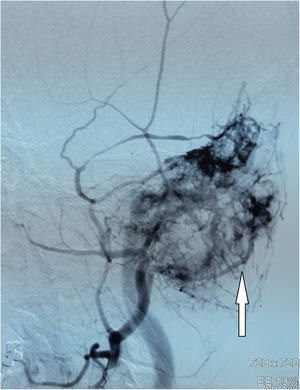 DSA indicates a hypervascular tumor of the left temporo-occipital region (white arrow).