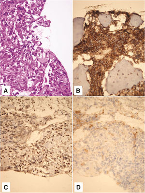 On hematoxylin - eosin staining, tumor was composed of small, poorely differentiated cells with hyperchromatic nuclei and scant cytoplasm (A). Tumor cells showed membrane positivity for CD 99 (B) and nuclear positivity for FLI1 (C). Negative staining for CD 31 tumor cells ruled out the possibility of a vascular lesion (D). Magnification ×400.