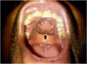 A clinical photograph on an osteolipoma of the hard palate in the oral cavity.