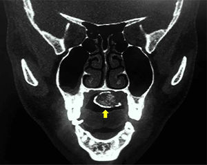 A coronal CT scan of the patient in Fig. 2 showing a hypodense mass (fat attenuation centrally) with peripheral hyperattenuation (calcification).