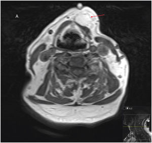 An axial MRI of another patient (histologically confirmed osteolipoma) showing a well circumscribed tumour with high signal intensity on T1.