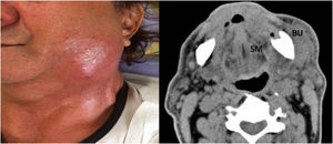 Case # 1. A 74-year-old man without comorbidities presented with an odontogenic infection of the left posterior lower teeth and who was hospitalized for 3 days. (a) Left front view revealing swelling in the lower left third of the face; (b) Contrast enhanced CT revealing a collection in the homolateral Submandibular (SM) and Buccal (BU) spaces.