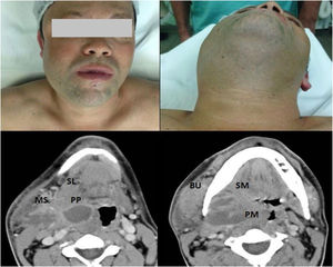 Case # 2. A 49-year-old male smoker presented with an odontogenic infection of the right upper third molar and who was hospitalized for 14 days, including 4 days in the ICU. (a) Areas of swelling in the right hemiface; (b) Areas of swelling in the submandibular region; CT with contrast revealing a collection in the Parapharyngeal (PP) space extending to the Sublingual (SL) and Masseteric (MS) spaces; (d) Collection in the ipsilateral Pterygomandibular (PM), Submandibular (SM) and Buccal (BU) spaces, promoting medial displacement of the right palatal tonsil and luminal reduction of the oropharynx (e) Collection in the right Masseteric Space (MS).