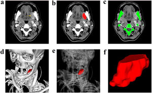 Contrast enhanced computed tomography scan: left retromolar trigone lesion (A). Manual segmentation of the tumor (B). Automatic segmentation of the skeleton (C). Tumor Three-Dimensional Segmentation (3DS) model along with modifiable bone transparency (D and E). Tumor spatial configuration (F).