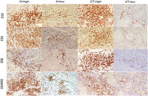 Immunohistochemical staining of CD3+TILs in HNSCC. Representative examples of high and low infiltration of CD3, CD4, CD8, and CD45RO positive cells in tumor margin and center of larynx squamous cell carcinoma. Original magnification ×200.