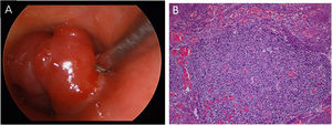 (A) The mass seen during the operation. (B) The histopathology showed well-circumscribed and solid lesion, slightly eosinophilic cytoplasm surrounded by dilated capillary-sized vessels, the cells were without obvious mitotic phase.
