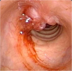 The tumor recurred in situ one year later.