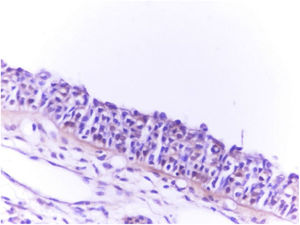 Severe (+3) immunostaining of concha bullosa surgical material with the olfactory marker protein (OMP, ×400).