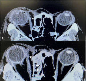 A, Preoperative axial Computed Tomography (CT) of the orbit showing transection of the medial rectus muscle. Arrowheads indicate the site of transection. B, Postoperative axial CT of the orbit showing retrieval of the medial rectus muscle. Arrowheads indicate the reconstructed medial rectus muscle. Arrows indicate the reconstructed medial wall of the orbit.