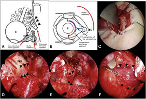 Surgical schema and images. Arrowheads show the proximal fragment of the transected medial rectus muscle. A, A combination of three different approaches is shown in the axial view. The distal fragment of the medial rectus muscle (dMRM) was recognized with the conventional sub-Tenon approach. The proximal fragment of the medial rectus muscle was recognized through the endoscopic transnasal approach supported by medial orbitotomy. B, The incision for the conventional sub-Tenon approach and the modified Lynch incision are shown as red lines. The lacerations in the conjunctiva are shown as blue lines. C, A modified Lynch incision was performed. The medial canthal tendon (MCT) was identified at the caudal end of the incision. D, The proximal fragment of the transected medial rectus muscle was identified through the periosteum of the medial wall of the orbit (PMW). View from a 0-degree telescope. E, The proximal fragment of the transected medial rectus muscle was surrounded by orbital fat. The contents of the orbit were retracted by the second surgeon with an elevator via the medial orbitotomy. View from a 0-degree telescope. F, The proximal fragment of the transected medial rectus muscle was easily recognized from the anterior view with a 70-degree angled telescope. G, Globe; LS, lacrimal Sac; MC, Medial canthus; P, Pupil.