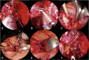 Surgical images. Arrowheads show the proximal fragment of the transected medial rectus muscle. A, A suture was hooked to the proximal fragment of the transected medial rectus muscle. View from a 0-degree telescope. B, The suture hooked to the proximal fragment of the transected medial rectus muscle was transferred to the ophthalmologist using a sub-Tenon approach. View from a 0-degree telescope. C, The proximal fragment of the transected medial rectus muscle was brought forward to the peribulbar space. (D and E) The medial rectus muscle was retrieved completely using a suture. F, The medial wall of the orbit was fixed with a silastic sheet. View from a 0-degree telescope. dMRM, Distal fragment of the medial rectus muscle; G, Globe; MW, Medial wall of the orbit.