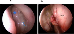 (A) Left-side middle meatus nasal polyp (blue arrow) and olfactory cleft hamartoma (blue star). (B) Extensive hamartoma in the right-side olfactory cleft, with septal invasion.