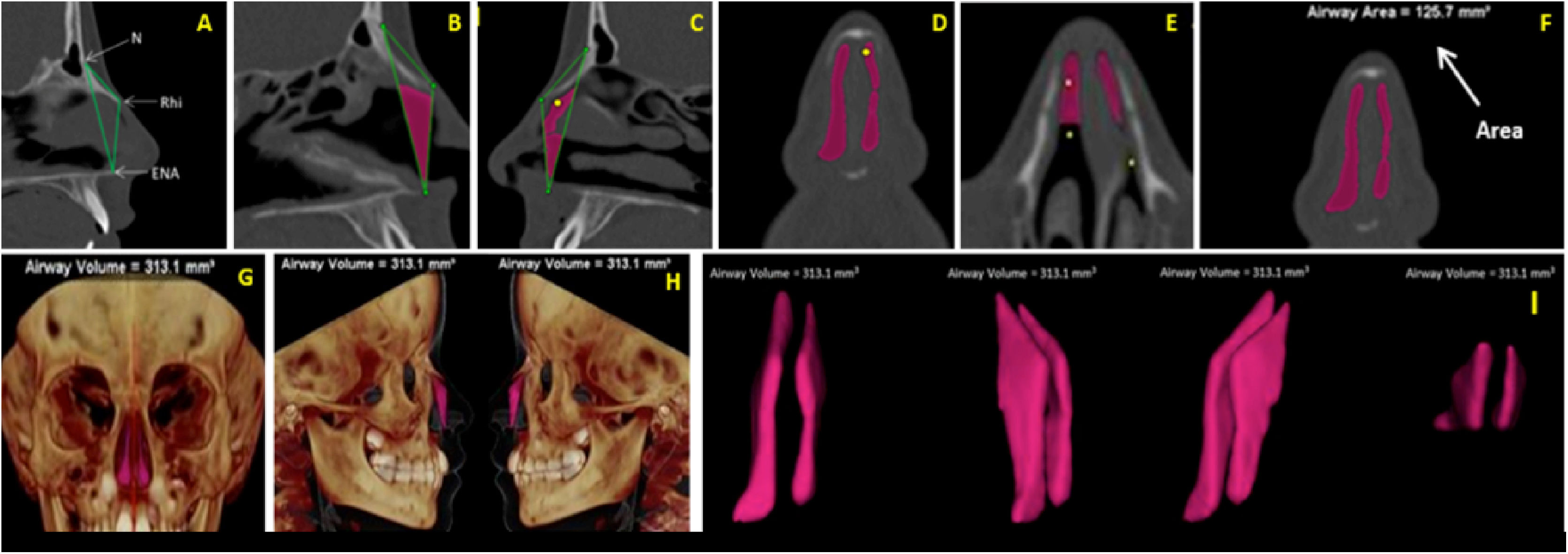 Three-dimensional image study of accelerated maxillary expansion in ...
