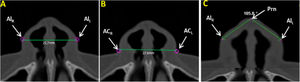 Axial multiplanar images illustrating: (A) Alar Width (AlR–AlL), (B) Soft tissue Insertion Width (ACR–ACL), (C) Alar Inclination Angle (ACR-Prn. ACL-Prn).
