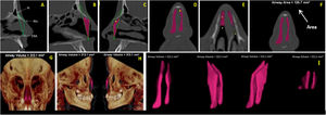 (A) Sagittal multiplanar image illustrating the anterior skeletal segmentation of NC through the anatomical landmarks of choice. (B‒C) Filling of NC to obtain volume and area, on the sagittal multiplanar image on the right and left sides, respectively. (D‒E) Filling of NC to obtain volume and area in coronal and axial multiplanar images, respectively. (F) Achievement of the total area (ArT). (G‒H) Total volume obtained and illustrated in 3D reconstruction images in right and left coronal and sagittal views, respectively. (I) Image illustrating the total anterior volume of the NC, delimited by bone tissues, extracted from surrounding tissues.