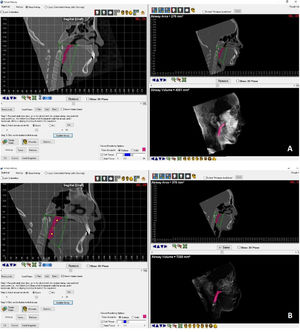 Measurement of the oropharynx airway volume pre-RME (A) and post-RME (B), using the Dolphin imaging software.