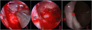 The retention cyst in the left lateral wall. Extraction of the cyst (A), cauterization of the base (B), and IMA opening at 12-months postoperatively (C). IM, Inferior Meatus; MF, Muco-periostal Flap; MW, Medial Wall. Black triangle indicated the retention cyst.