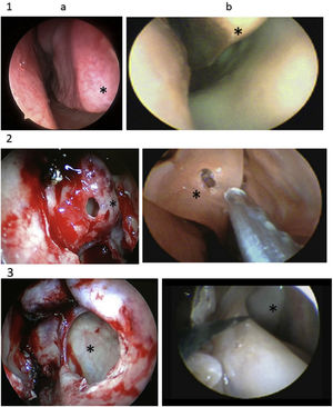 Human (a) and lamb (b) anatomy. 1. Inferior turbinate (*); 2. bullectomy (*); 3. maxillary sinus (*).
