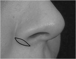 Modified Weir incision on the alar-facial groove.