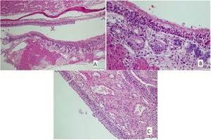 (A) Goblet cell hyperplasia, increased inflammation, loss of cilia, and increased eosinophils in Allergic Rhinit model (HE × 40). (B) Congestion and increased vascularisation in Allergic Rhinit model (HE × 40). (C) Chondrosithipertrophy in Allergic Rhinit model (HE × 40).