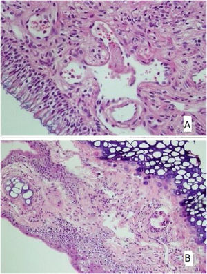 (A) The section in which the cilia are clearly observed, and there is no inflammation and eosinophil increase in the mometasone furoate treatment group(HE × 40) and (B) the section where inflammation is not observed, cilia are preserved, and goblet cell hyperplasia is not observed in the Nigella sativa oil treatment group (HE × 40).
