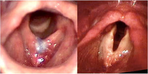 Laryngeal image of granuloma pre- (left) and post-treatment (right), patient #7.