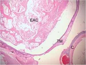 Histological section of right ear stained with H&E, 16 weeks after obliteration of the external auditory canal. External Auditory Canal (EAC) filled with epithelial debris, secretions, and keratin, promoting medial displacement of the Tympanic Membrane (TM), without contact with the Cochlea (C) (Stage 2 cholesteatoma). The blank space between the mass of keratin/epithelial debris occupying the EAC and TM is an artifact incorporated during fixation.