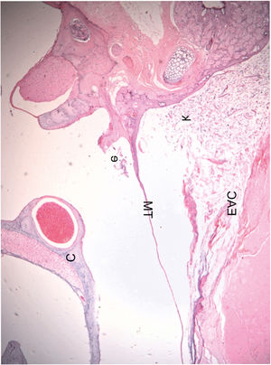 Histological section of an ear 16 weeks after obliteration of the external auditory canal: presence of a few inflammatory cells in the middle ear (C, Cochlea; TM, Tympanic Membrane; EAC, External Auditory Canal; e, Effusion (inflammatory cells); k, Keratin). The blank space between the mass of keratin/epithelial debris occupying the EAC and TM is an artifact incorporated during fixation.