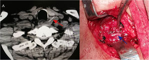 The CT scan showing a linear object of high density in the left tracheoesophageal groove (A), the left RLN was kept intact during the fishbone removal surgery (B).