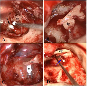 Endoscopic view of bone cement utilization (A), incus interposition (B) and PORP placement (C) in type-II reconstruction. Endoscopic view of TORP placement is seen in (D). Black arrow, bone cement; s, stapes; I, Incus; m, malleus; ig, incus-graft; * PORP; cg, cartilage graft; blue arrow, TORP.