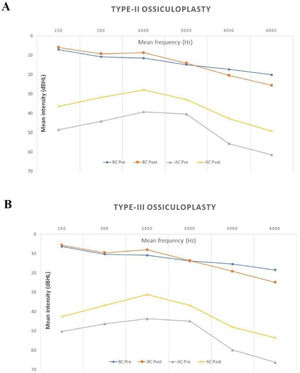 Mean pre- and postoperative audiometric results (A, B) including bone and air conduction data for Type II and III ossiculoplasties, respectively.