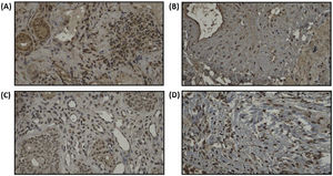 Immunoreactivity staining of PAI-1 expression. PAI-1 expression before treatment in intervention group (A) and in control group (B). PAI-1 expression after 4 weeks of treatment in radiofrequency group (C) and in control group (D).
