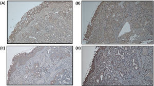 Immunoreactivity staining of MMP-9 expression. MMP-9 expression before treatment with 3(+) in radiofrequency group (A) and in control group (B). Reduction of MMP-9 expression 4 weeks after treatment with 1(+) in radiofrequency group (C) and 2(+) in control group (D).
