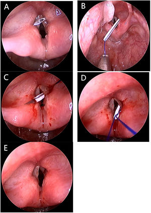 Endoscopic suture lateralization (A). Placement of 18-gauge needle superior to the vocal cord (B). Introduction of suture #1 (C). Placement of the 22-gauge needle inferior to the vocal cord for introduction of suture #2 (D). Passage of suture #1 through the loop of suture #2 (E). Lateralization suture under tension after securing to subcutaneous button in neck.