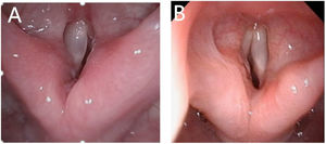 Postoperative flexible laryngoscopy (A). One year after right-sided EPSL (B). One year after left-sided EPSL.