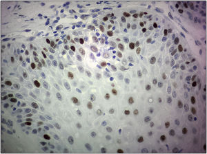 Photomicrograph illustrating immunohistochemical reaction revealing squamous epithelium with nuclear positivity for p53 protein (p53, ×400). Source: The author (2021).
