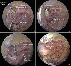 Transnasal endoscopy-guided percutaneous access to the sphenopalatine ...