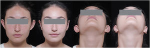 Pre- and post-operative picture of patient without concha resection.