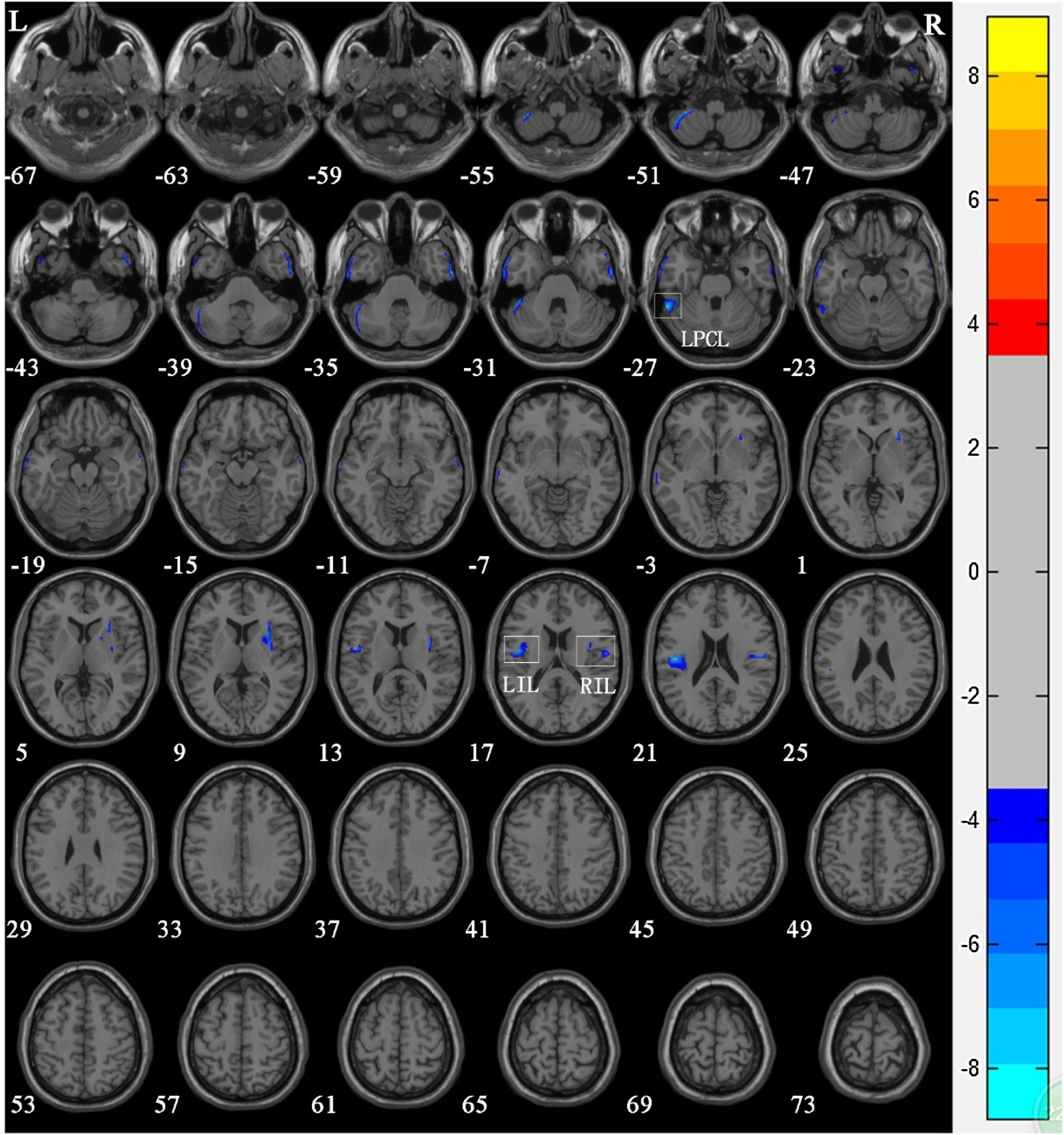 Changes in brain gray matter volume in nasopharyngeal carcinoma ...