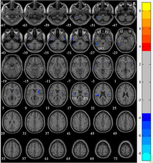 Voxel-based morphometry shows a reduction in gray matter volume in NPC patients after radiotherapy compared to that of the normal control Group. The numbers in the figure are the z-axis coordinates of Montreal Neurological Institute space. The color bar is t-value. The images show areas of significantly reduced gray matter volume in Left Posterior Cerbellar Lobe (LPCL), Right Insular Lobe (RIL), and Left Insular Lobe (LIL).