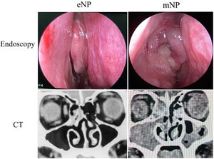 Representative images of eNP and mNP in endoscope and CT scan.